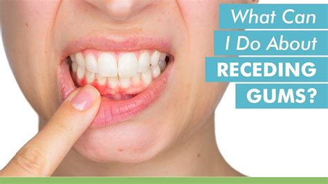 (3) Include a photograph if the question relates to something you can see in your mouth, include. . I healed my receding gums reddit